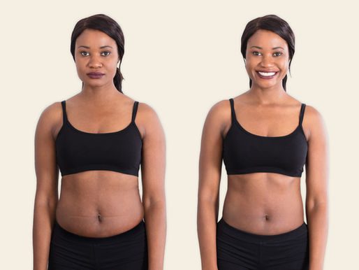 Mide Botoksu Nedir? Nasıl Yapılır?