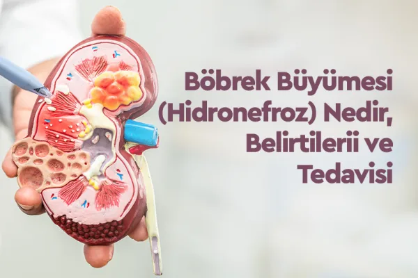 Böbrek Büyümesi (Hidronefroz) Nedir, Belirtileri ve Tedavisi 