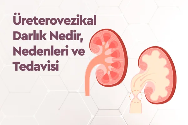 Üreterovezikal Darlık Nedir, Nedenleri ve Tedavisi 