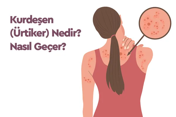 Kurdeşen(Ürtiker) Nedir? Kurdeşen(Ürtiker) Nasıl Geçer?