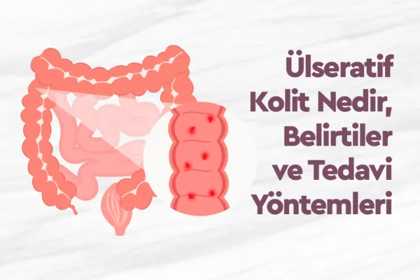Ülseratif Kolit Nedir, Belirtiler ve Tedavi Yöntemleri