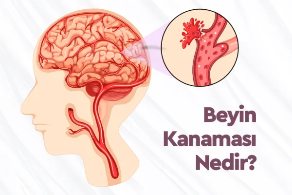 Beyin Kanaması Nedir? Belirtileri, Nedenleri ve Tedavi Yöntemleri