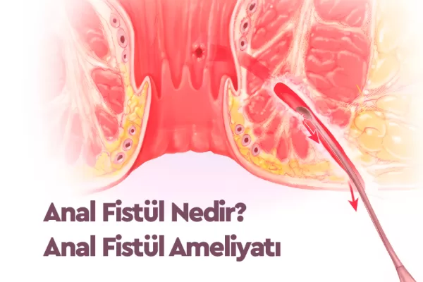 Anal Fistül Nedir? Anal Fistül Ameliyatı