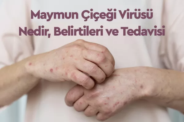 Maymun Çiçeği Virüsü Nedir, Belirtileri ve Tedavisi