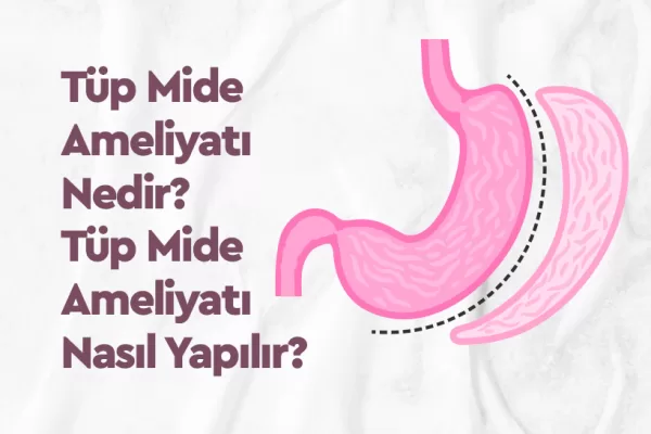 Tüp Mide Ameliyatı Nedir? Tüp Mide Ameliyatı Nasıl Yapılır? 2 Tüp Mide Ameliyatı Nedir? Tüp Mide Ameliyatı Nasıl Yapılır?