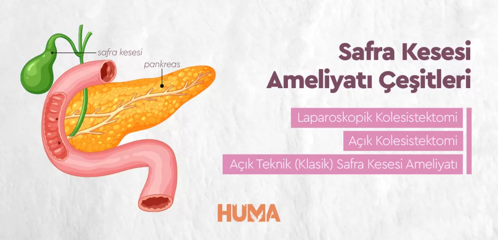 Safra Kesesi ameliyat Cesitler