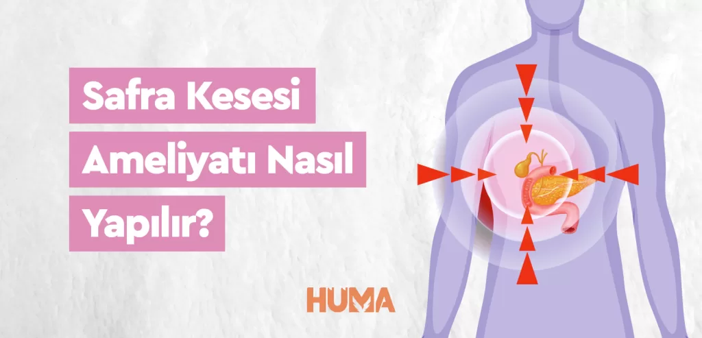 Safra Kesesi ameliyat nasil yapilir