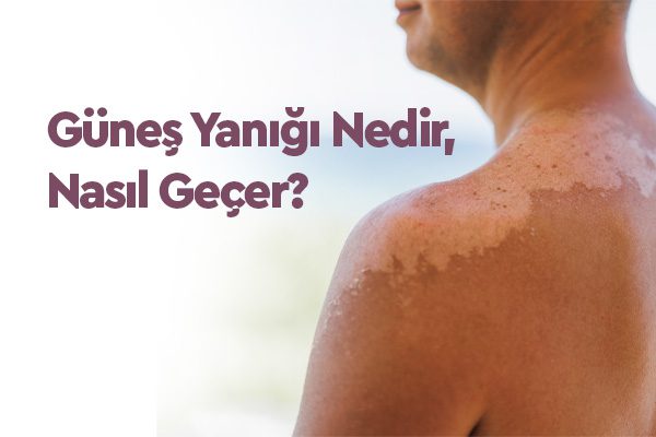 Güneş Yanığı Nedir, Nasıl Geçer? 