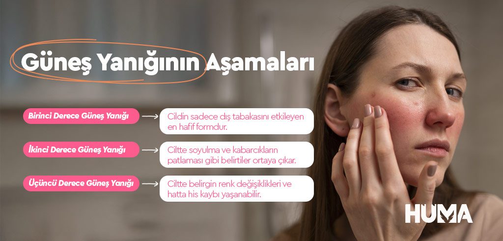 Güneş Yanığı Nedir, Nasıl Geçer? 1 gunes yanigi2