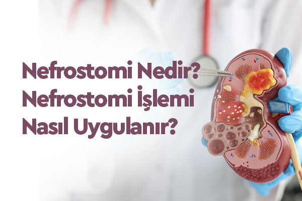 Nefrostomi Nedir? Nefrostomi İşlemi Nasıl Uygulanır? 