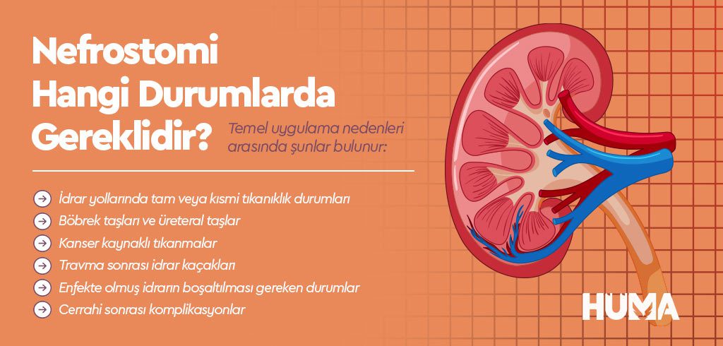 Nefrostomi Nedir? Nefrostomi İşlemi Nasıl Uygulanır?  2 nefrostomi3