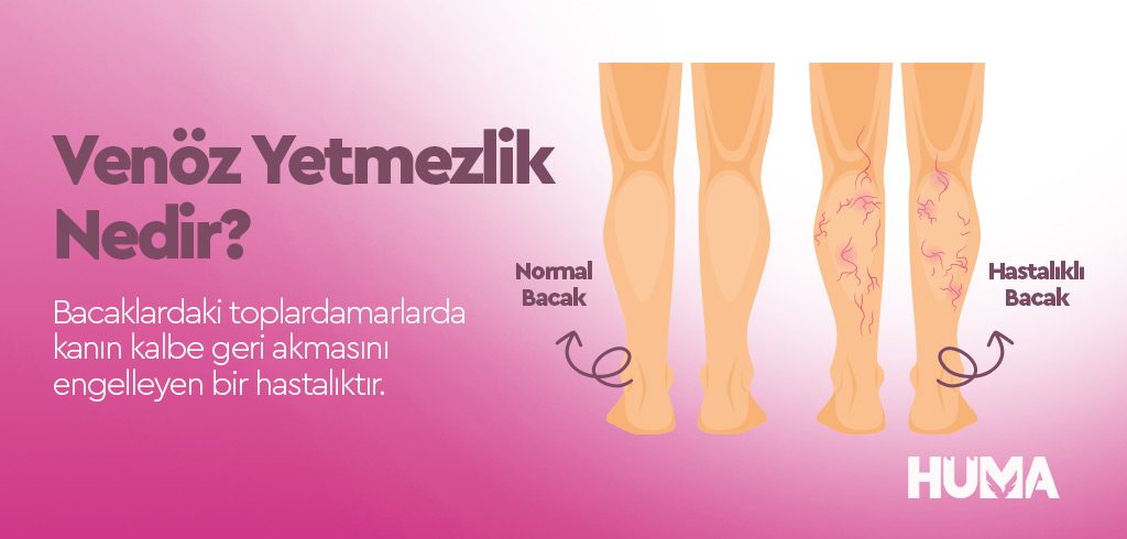 Venöz Yetmezlik Nedir? Belirtileri, Nedenleri ve Tedavi Yöntemleri 1 venoz yetmezlik2